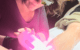 épilation laser