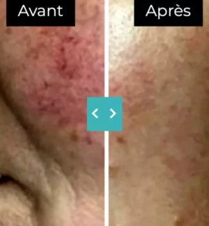 Lésions vasculaires Lésions vasculaires