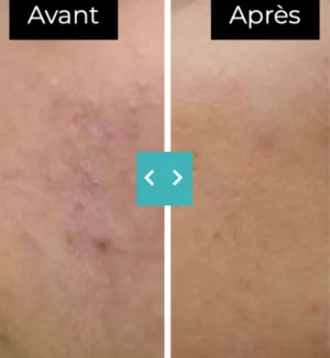 Veinules et varicosités Veinules et varicosités